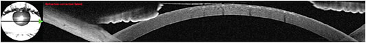 Figure 5: AS-OCT demonstrates hyaline deposits in the subepithelial space OS. IMAGE COURTESY HANS W. ANDREWS, MD