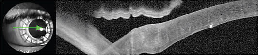 Figure 2: Note the resolution of granular deposits OD after the DALK procedure. IMAGE COURTESY HANS W. ANDREWS, MD