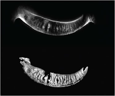 Meibomian gland atrophy and tortuosity are common in patients seeking refractive surgery, study showed. IMEIBOGRAPHY CAPTURED USING TEARSCIENCE LIPIVIEW II (JOHNSON &amp; JOHNSON VISION, SANTA ANA, CA).