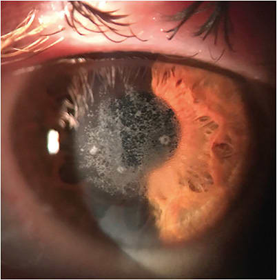 Figure 6: Note the LASIK patient’s eye OS preoperatively.IMAGES COURTESY HANS W. ANDREWS, MD