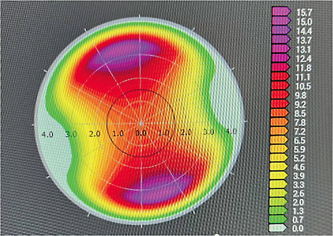 FIGURE 1: The treatment will remove 16 μm in the areas in purple. IMAGE COURTESY MARK LOBANOFF, MD