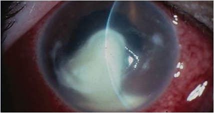 Severe bacterial keratitis.