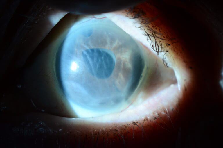 Corneal Edema