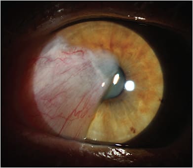 What is the role of proteins in cataract development? University of Arizona –Tucson researchers hope to find out. STOCK.ADOBE.COM / ZVITALIY79