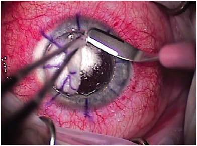 FIGURE 2. The removal of the anterior stroma with a crescent blade after achieving the big bubble (bulk keratectomy).IMAGE COURTESY W. BARRY LEE, MD, FACS