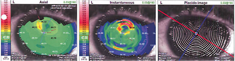 FIGURE 4: Mires on topographic Placido disc imaging show corneal irregularity.