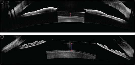 AS-OCT images depicting adequate vaults (250 μm and 740 μm, respectively) of an ICL over the natural crystalline lens.IMAGE COURTESY KATHRYN HATCH, MD