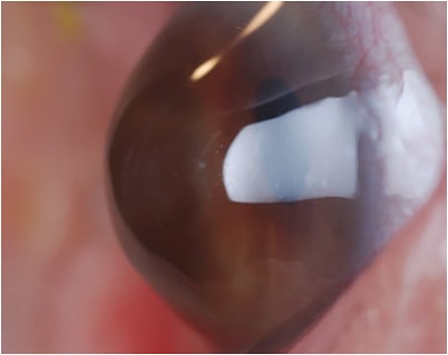 Side view of a scleral lens on an eye that has severe KCN. IMAGE COURTESY EDWARD BOSHNICK, MD