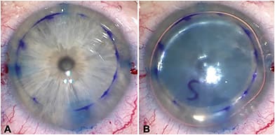 FIGURE 1: Trypan blue dye aids in the determination of optimal graft size, and acts as a guide for graft positioning.IMAGE COURTESY LAURA PALAZZOLO, MD, &amp; DEEPINDER K. DHALIWAL, MD, L.AC