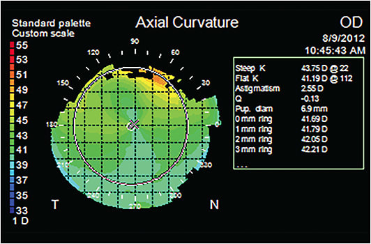 FIGURE 2: Terrien’s marginal degeneration places refractive surgery patients at risk for corneal weakness. IMAGE COURTESY STEVEN E. WILSON, MD