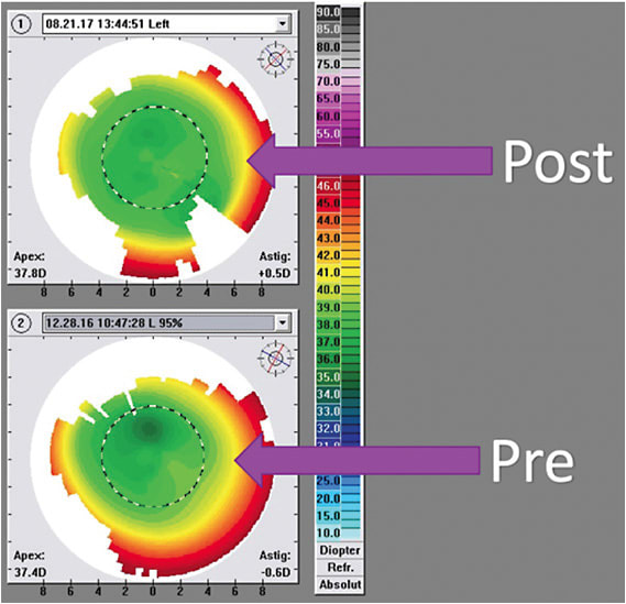 FIGURE 4: Topography aids in guiding treatment. IMAGE COURTESY MARK LOBANOFF, MD