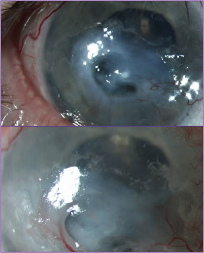 Figure 7. Descemetocele in the right eye (top); amniotic membrane over thinning cornea (bottom).