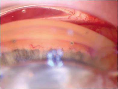 FIGURE 1: Note the 2 iStent inject stents placed into the canal bypassing the trabecular meshwork 2 clock hours apart. IMAGE COURTESY I. PAUL SINGH, MD