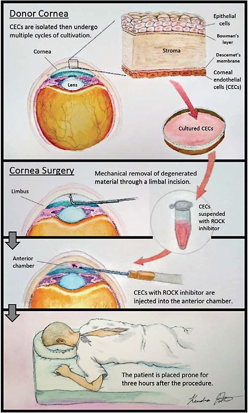 Face-down positioning promotes the migration of CECs toward the inner corneal surface