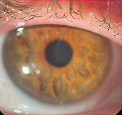 Figure 8: The patient’s epithelium healed without complication. IMAGE COURTESY HANS W. ANDREWS, MD