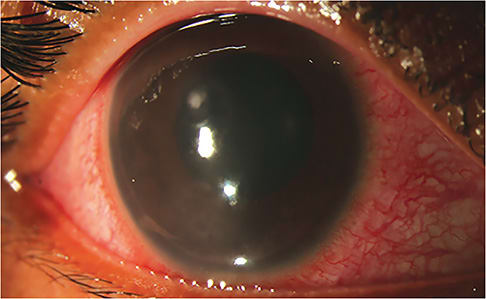 Low-risk MKs are small, peripheral, or paracentral and non-sight-threatening. IMAGE COURTESY ZAINA N AL-MOHTASEB, MD