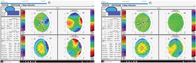 FIGURE 3 &amp; 4: Right eye topography of pterygium before and after treatment in a patient desiring refractive cataract surgery. IMAGE COURTESY DENISE M. VISCO, MD, MBA