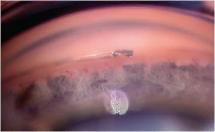 FIGURE 2: Note the Hydrus microstent scaffolding the canal for 3 clock hours with half of the inlet in the canal and half in the AC bypassing TM. IMAGE COURTESY I. PAUL SINGH, MD