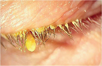 Note the severe collarettes in this blepharitis patient. IMAGE COURTESY ELIZABETH YEU, MD