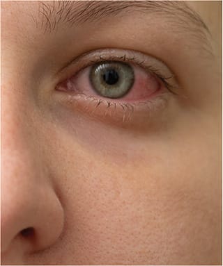 Reports have highlighted conjunctivitis as the main ocular manifestation of SARS-CoV-2-infected patients.STOCK.ADOBE.COM / LUUUUSA