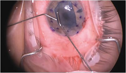 FIGURE 2: Peter Veldman, MD, demonstrates reorientation of the graft to facilitate its unfolding. IMAGE COURTESY PETER VELDMAN, MD