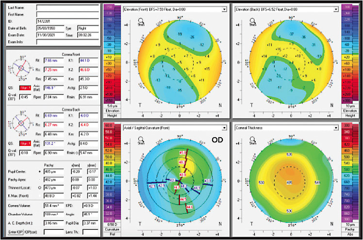FIGURE 1: Tomography of the right eye, demonstrating longstanding KCN. IMAGE COURTESY KATHRYN HATCH, MD