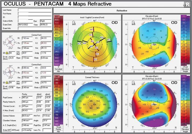 Note this post-LASIK patient’s topography after TCAT. IMAGE COURTESY MARK LOBANOFF, MD.