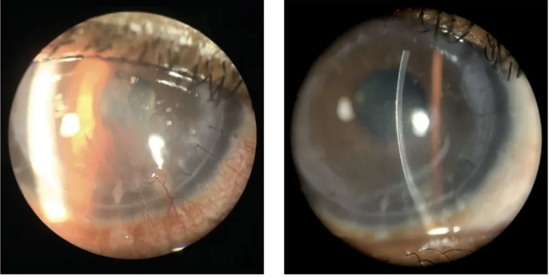 Left: CNV prior to corticosteroid intervention. Right: CNV after corticosteroid intervention. Corticosteroids provide potent anti-inflammatory effects. IMAGES COURTESY ALBERT Y. CHEUNG, MD