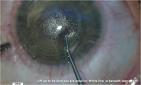 FIGURE 1: Lenticule dissection showing the instrument anterior to the lenticule. IMAGE COURTESY AUDREY TALLEY ROSTOV, MD