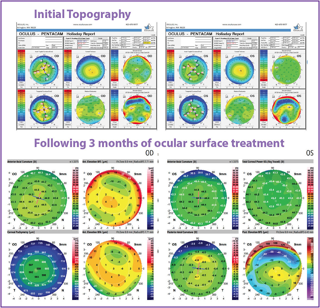 Figure 4. Initial corneal topography (top) shows areas of elevation and depression. After 3 months of treatment (bottom), topography was much improved.