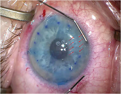 FIGURE 2: Note the fibrin-limiting DMEK graft unfolding. Red arrows: Persistent DMEK fold due to fibrin. IMAGE COURTESY LAURA PALAZZOLO, MD, &amp; DEEPINDER K. DHALIWAL, MD, L.AC