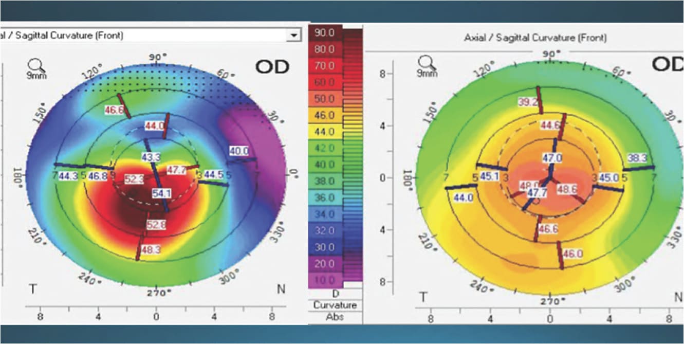 FIGURE 2: Same patient as Figure 1, showing preoperative topography and postoperative topography. The patient did well with a spherical IOL at the time of cataract surgery.