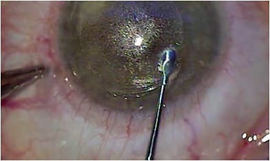 FIGURE 2: Lenticule dissection showing the elevation of the instrument to be sure that it is anterior and demonstrating the “white line” of the lenticule posterior to the lenticule plane. IMAGE COURTESY AUDREY TALLEY ROSTOV, MD