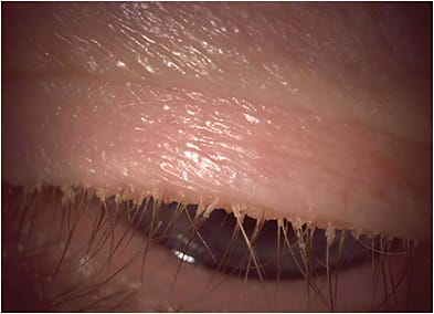 Treating lid disease and blepharitis and eliminating bacterial overgrowth helps to reduce the risk of infection or endophthalmitis.