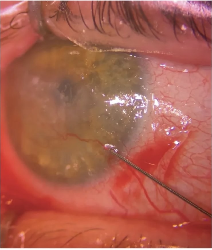 MICE involves injection of minute amounts of 0.4 mg/mL mitomycin (o.o1 mL to 0.05 mL) into CNV vessels near the limbus, with enough retrograde hydrostatic force to fill both the efferent and afferent vessels.