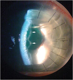 FIGURE 4. Note the double anterior chamber on postoperative day 1. Arrows denote the detached DM with saw-tooth folds.IMAGE COURTESY W. BARRY LEE, MD, FACS