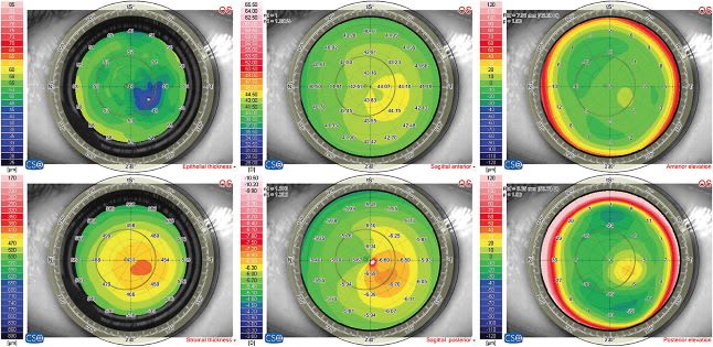 Figure 3. MS-39 (CSO, Florence, Italy) 6 map display of a patient with mild keratoconus, showing correspondence between epithelial thinning, pachymetric thinning, curvature, and elevation maps. IMAGES COURTESY DAN Z. REINSTEIN, MD, MA(CANTAB), FRCSC, FRCOPHTH