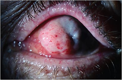 FIGURE 1: Note the elevated interpalpebral nasal conjunctival lesion extending into the nasal cornea. IMAGE COURTESY BEERAN MEGHPARA, MD