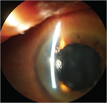 FIGURE 1: Note the elevated nodules evident on slit lamp examination.