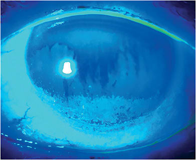 FIGURE 2: The CEDARS algorithm calls for both flourescein and lissamine staining of the cornea and conjunctiva, along with a slit lamp exam. IMAGE COURTESY DARRELL E. WHITE, MD