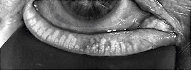 A patient with MGD and moderate atrophy of the glands.