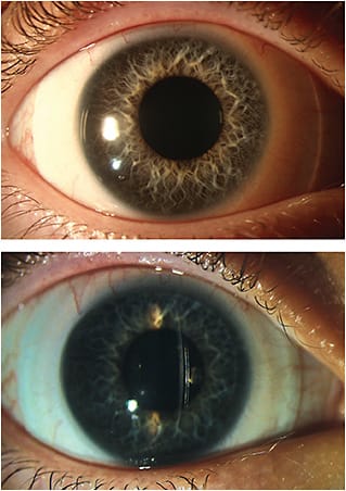 A patient with graft-versus-host disease and a history of severe DED, with chronic nonhealing epithelial defects elected to wear scleral contact lenses. These contact lenses have provided disease control when other methods have failed. Slit beam shows vaulting between the contact lens and the cornea. IMAGE COURTESY ANGELA VERKADE, MD