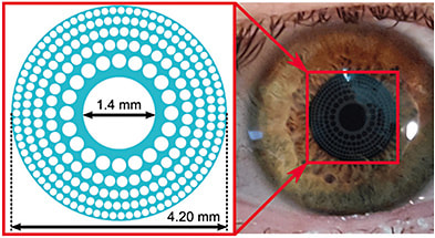 Transparent trifocal corneal inlay.IMAGE COURTESY UNIVERSITAT POLITÈCNICA DE VALÈNCIA