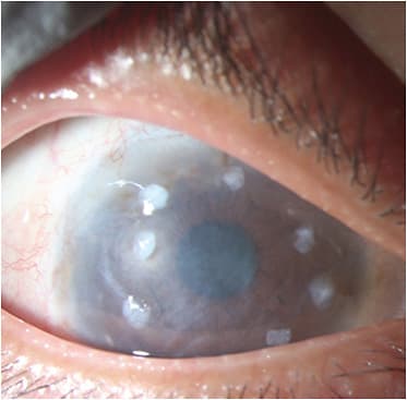 FIGURE 2: One month after undergoing ocular surface reconstruction with SLET placement. Picture shows 8 implants dissolving. Visual acuity was 20/200+2. IMAGE COURTESY GUILLERMO AMESCUA, MD