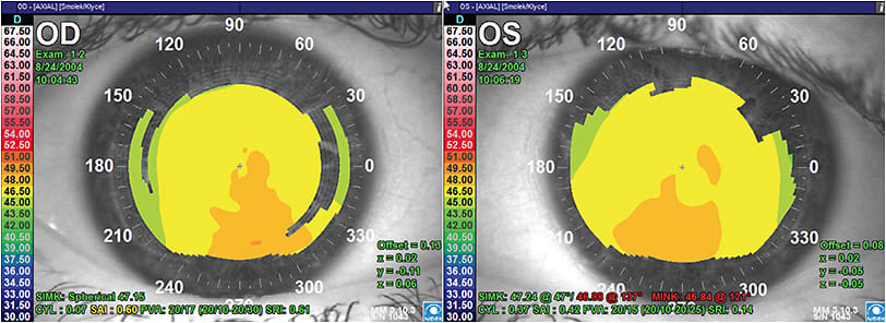 FIGURE 4: Contact lens-induced corneal warpage with irregularity and inferior steepening.