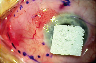 Figure 2. Intra-operative photograph showing wide, 4 mm, margin excision of the OSSN lesion. IMAGE COURTESY OF JENNIFER A. TRAN, MD