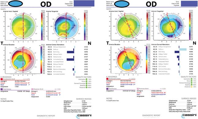 FIGURE 1 &amp; 2: Right eye topography of anterior basement membrane dystrophy before and after treatment in a patient desiring refractive cataract surgery. IMAGE COURTESY DENISE M. VISCO, MD, MBA