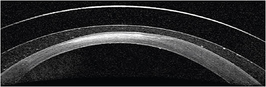 A patient with keratoconus and a corneal scar wears a scleral lens for vision. Anterior-segment OCT demonstrates the fluid cleft and vault between the lens and the cornea. Depending on scleral lens diameter, the desired vault over the apical cornea can range from 100 µm to 300 µm. IMAGE COURTESY ANGELA VERKADE, MD