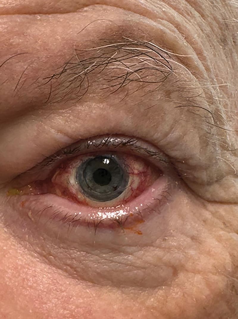 Figure 4: Clinical photograph of the first patient recruited in Paris for the second clinical trial 1-month postop.