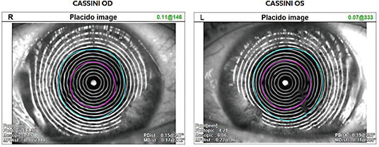 Warped and irregular placido disc mires confirming tear film instability.